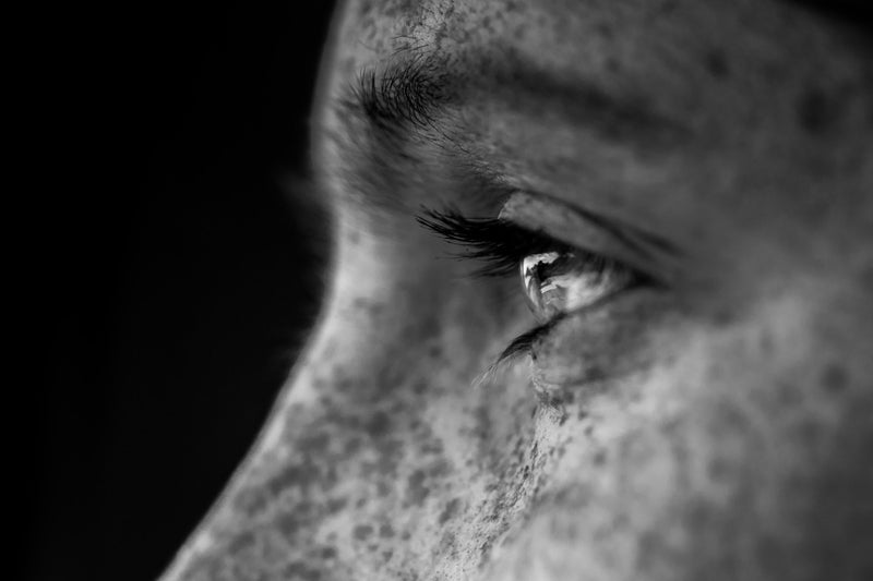 CBD para la psoriasis: lo que dice la investigación - Family Cbd Mexico