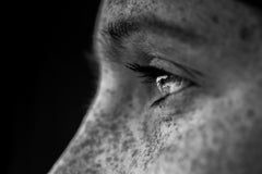 CBD para la psoriasis: lo que dice la investigación - Family Cbd Mexico